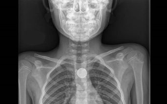 Batterie a bottone: in tre mesi sei ricoveri al Bambino Gesù