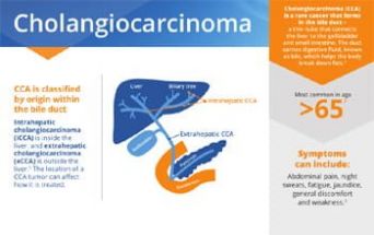 Grafica sul colangiocarcinoma