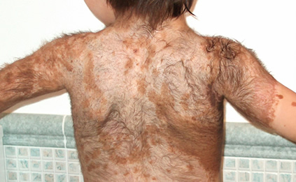 Nevo melanocitico congenito - Immagine esemplificativa (Fonte: Naevus Italia Onlus)